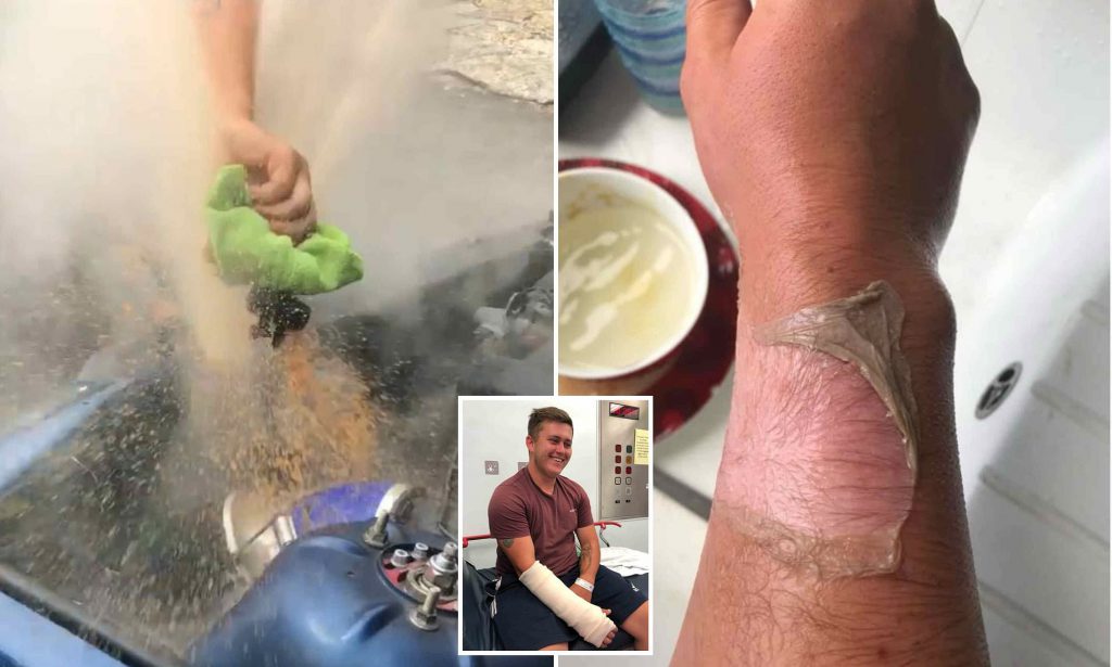 Opening the Radiator Cap When Hot Can Burn Your Hands Opening the Radiator Cap When Hot Can Burn Your Hands